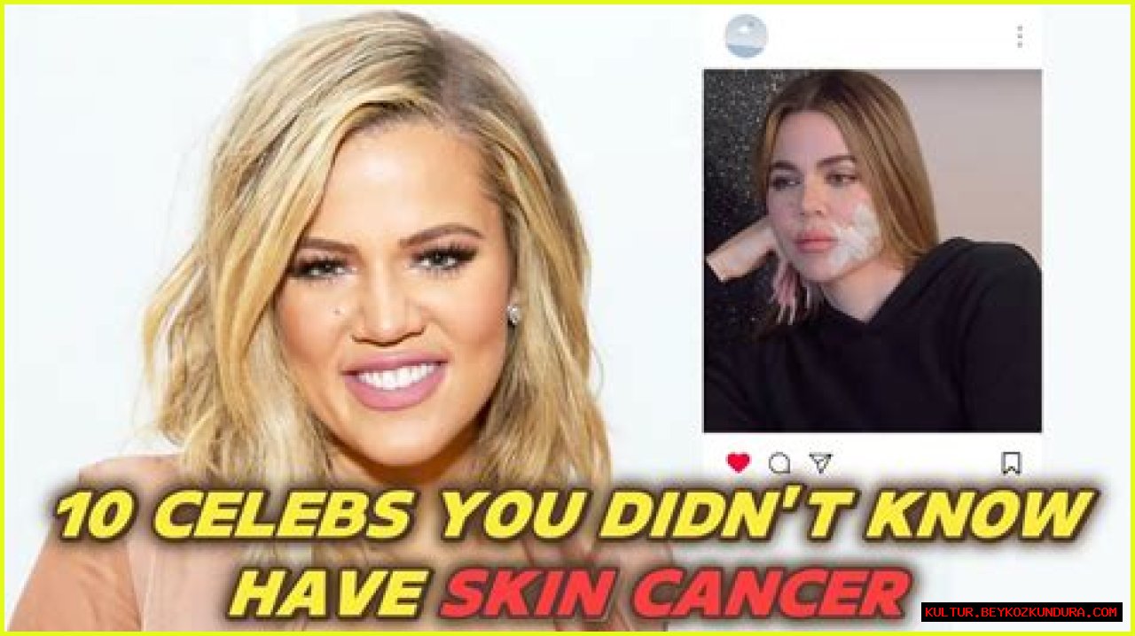 Unveiling The Tragic Tales: Celebrities Lost To Melanoma