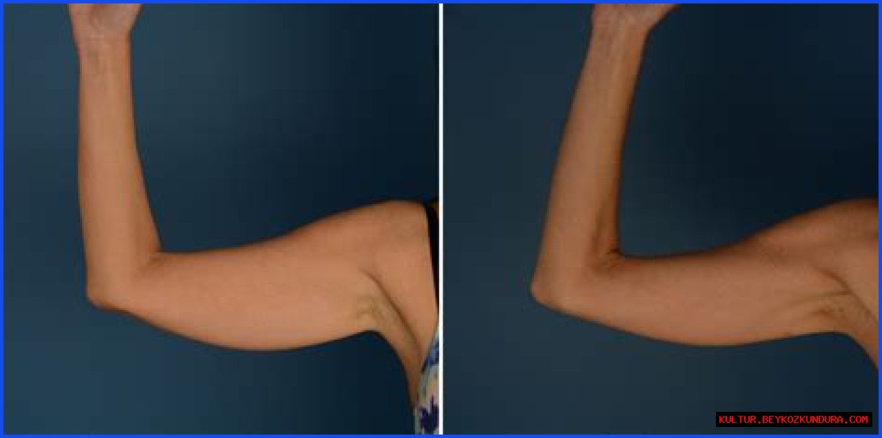 Unveiling The Wonders Of Armpit Liposuction: Discoveries And Insights